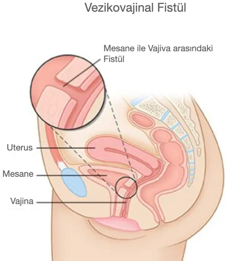 Vezikovajinal fistül: mesane ile vajina arasındaki fistülü gösteren anatomik çizim