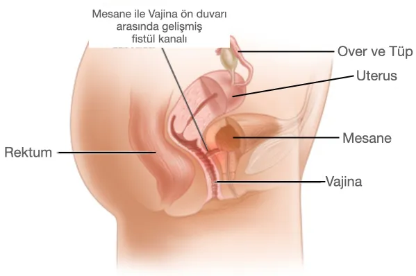 Mesane ile vajina ön duvarı arasında gelişmiş fistül kanalını gösteren anatomik çizim