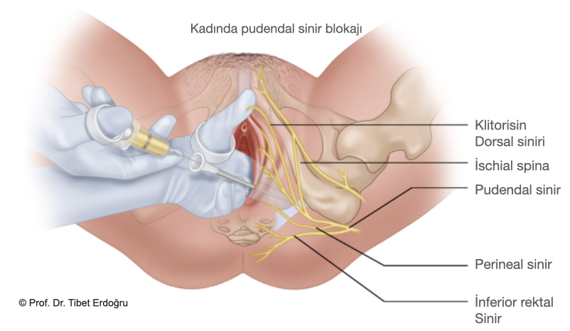Kadında pudendal sinir blokajı