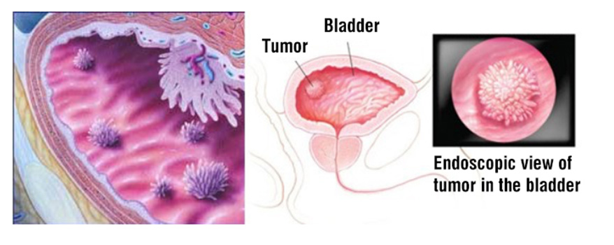 Bladder Cancer