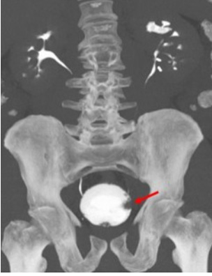 Bladder Cancer