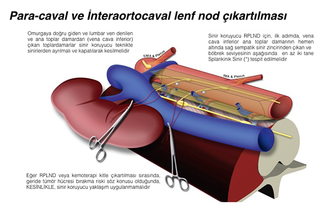 Retroperitoneal Lenf Nod Disseksiyonu (RPLND) ne demektir?