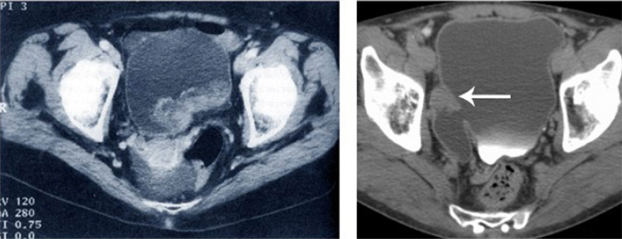 Bladder Cancer