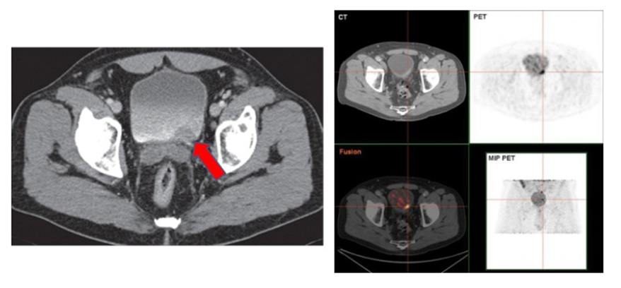 Bladder Cancer