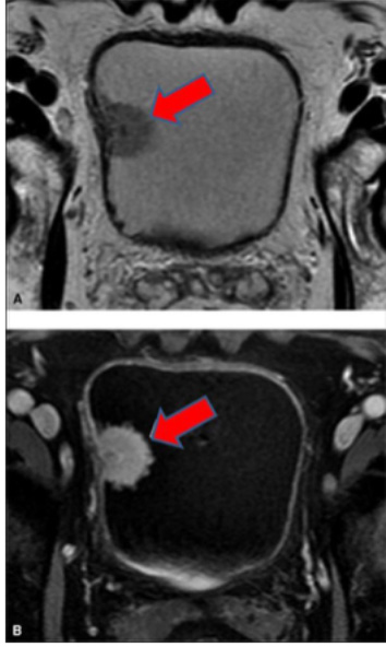Bladder Cancer