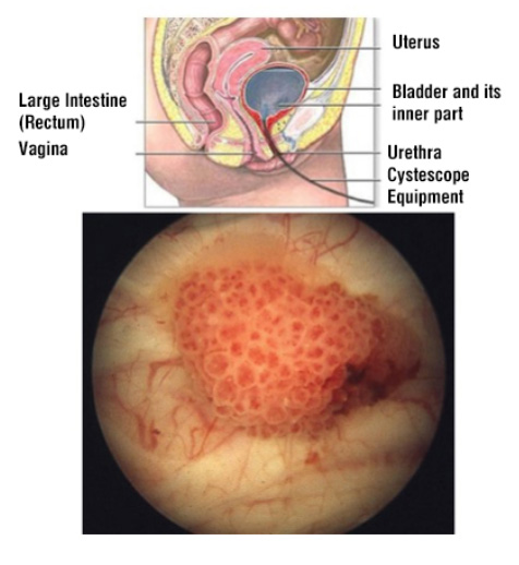 Bladder Cancer