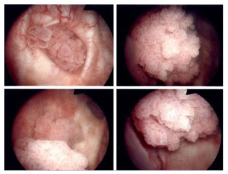 Bladder Cancer
