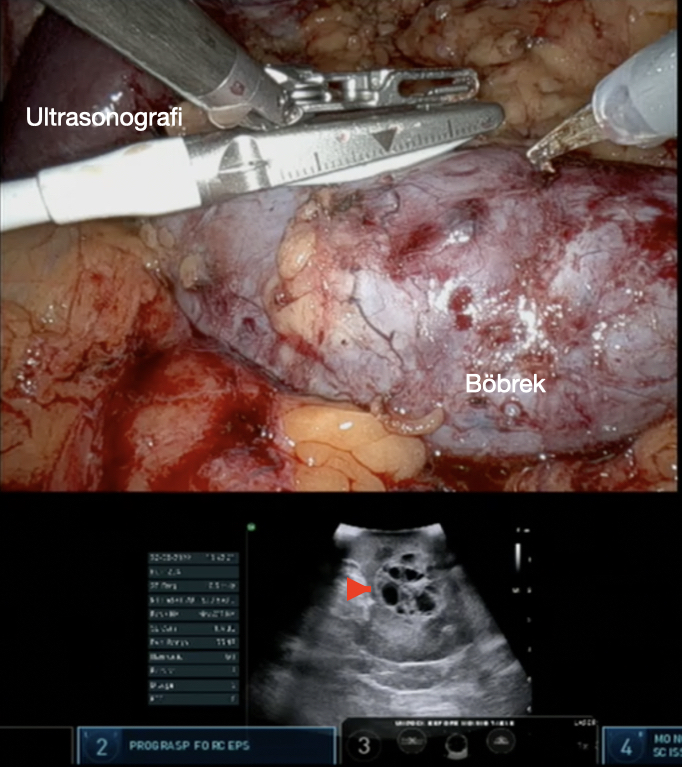 Böbreğe Tümüyle Gömülü Tümörlerde Robotik Ultrasonografi Kılavuzluğunda Robotik Parsiyel Nefrektomi