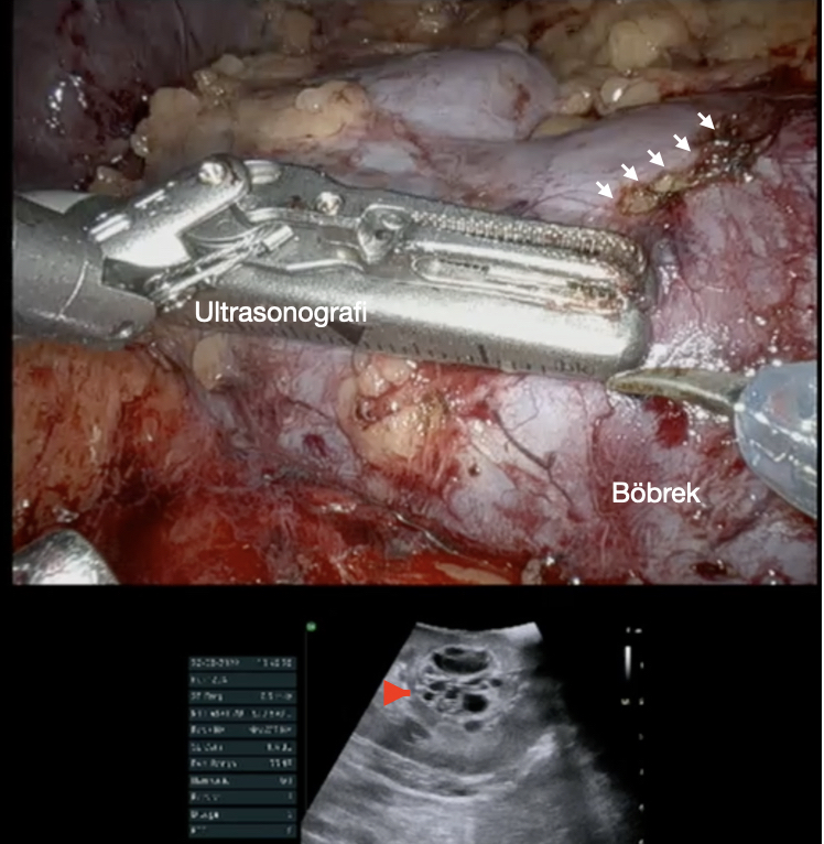 Böbreğe Tümüyle Gömülü Tümörlerde Robotik Ultrasonografi Kılavuzluğunda Robotik Parsiyel Nefrektomi