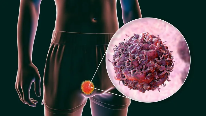 Erkeklerde En Sık Görülen Kanser: Testis Kanseri