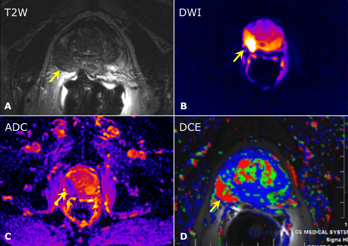 Prostat Kanseri Tanısında Multiparametrik Prostat MRI Nedir?