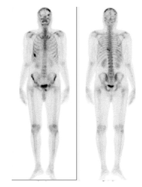 Sınırlı Kemik Metastazı Olan Prostat Kanserinin Tedavisinde Sitoredüktif Radikal Prostatektomi Başarısı