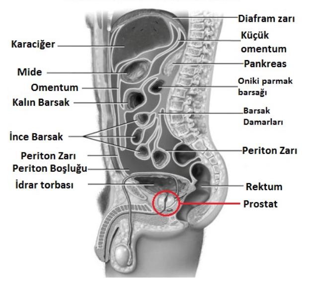 Prostat Kanserinde Fokal Tedavi Nedir?