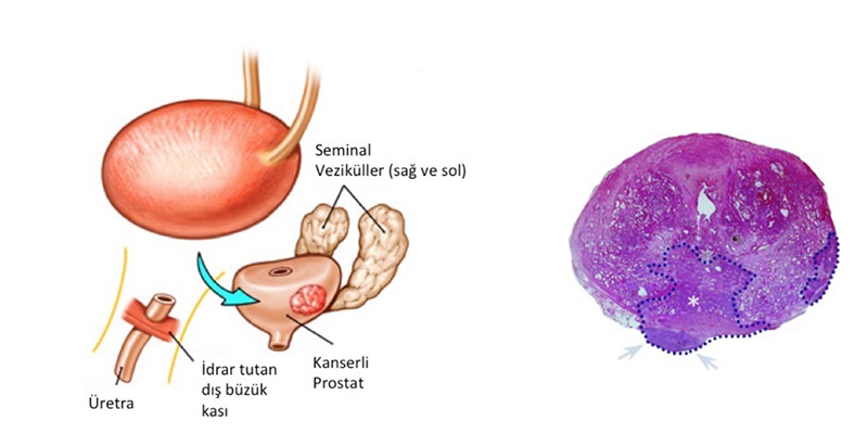 Sınırlı Kemik Metastazı Olan Prostat Kanserinin Tedavisinde Sitoredüktif Radikal Prostatektomi Başarısı
