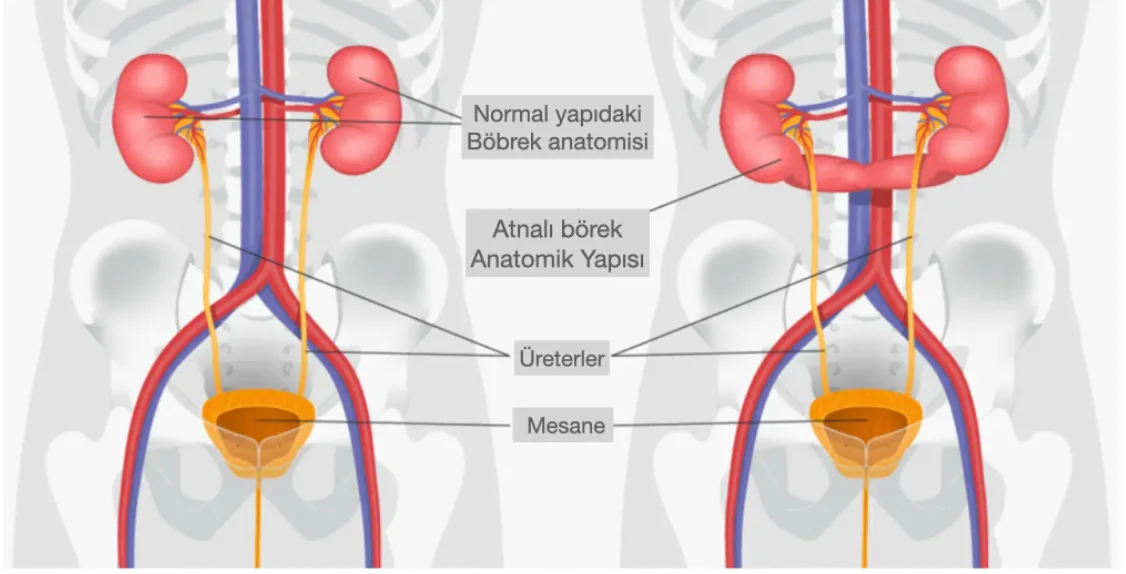Atnalı Böbrek Tümöründe Robotik Cerrahi
