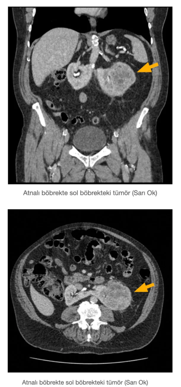 Atnalı Böbrek Tümöründe Robotik Cerrahi