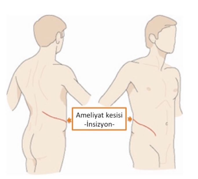 Şekil-1: Açık nefrektomi Açık böbrek cerrahisinde belin yan kısmındaki kaslara yapılan büyük cerrahi kesi ile karın duvarını yapan 3 kat kas ardışık oalrak kesilir. Bu kasların kesilmesine bağlı ciddi ağrı hissi ve yaranın büyüklüğü cerrahi sonrasındaki iyileşmeyi geciktirecektir.
