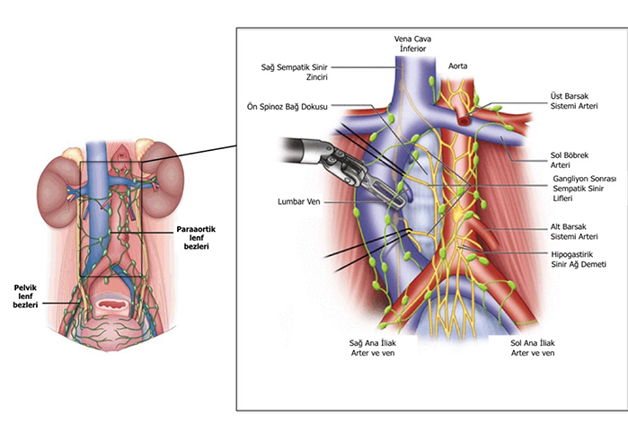 Retroperitoneal Lenf Nod Disseksiyonu (RPLND) ne demektir?