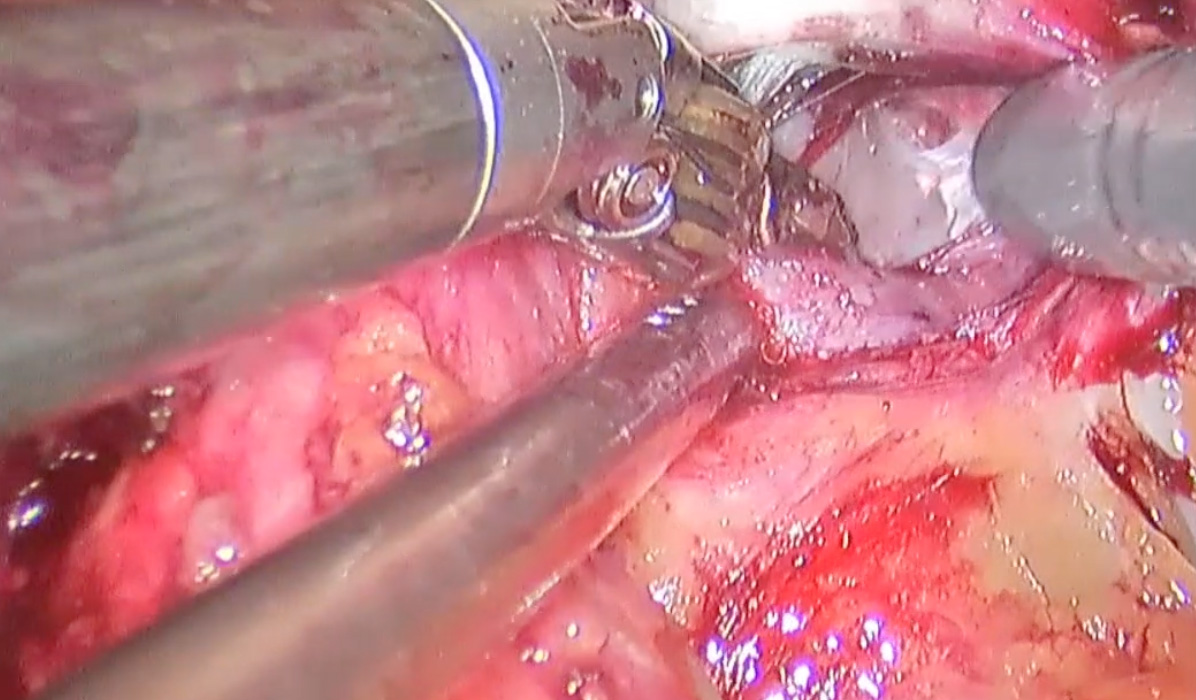 Prostat kapsülünün hemen lateralinde anterior vasküler yapılar ve onunda hemen inferiroundaki periprostatik ve levator fasciaları içinde sinir demetleri başlar. (Anatomik Fotoğraf Kaynak: Tewari A, BJU Int 2011)