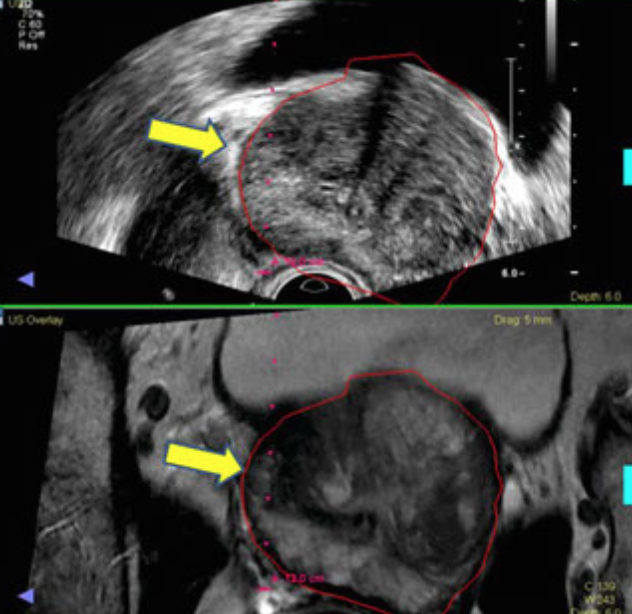 Ultrason, Mri Klavuzluğunda Prostat Biopsisi Nedir?