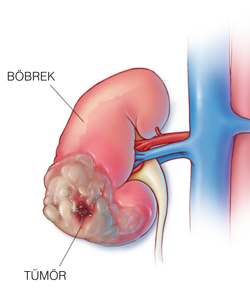 Böbrek Kanseri Belirtileri ve Risk Faktörleri