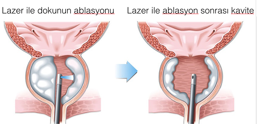 Prostat Büyümesinde Hangi Cerrahi Teknik Ne Zaman Tercih Edilmelidir?