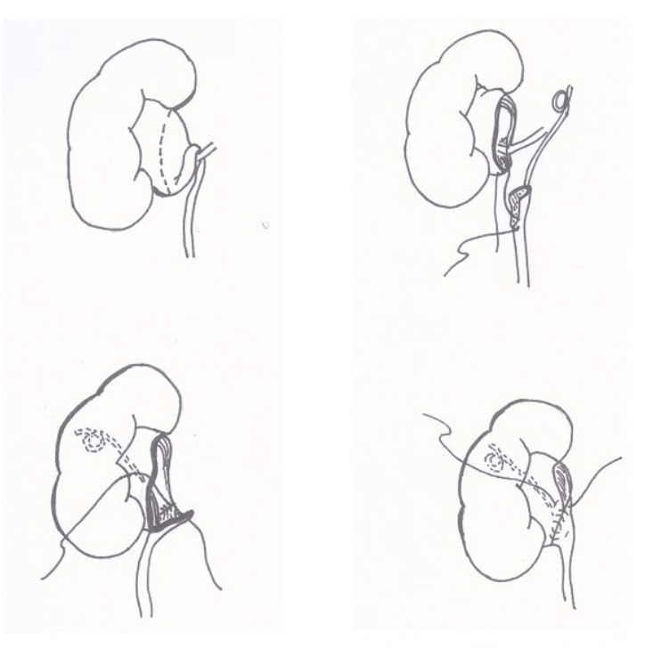 Robotic Pyeloplasty for UPJ Obstruction