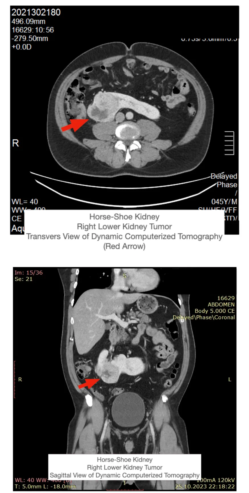 Robotic Surgery of Renal Cancer in Horseshoe Kidney