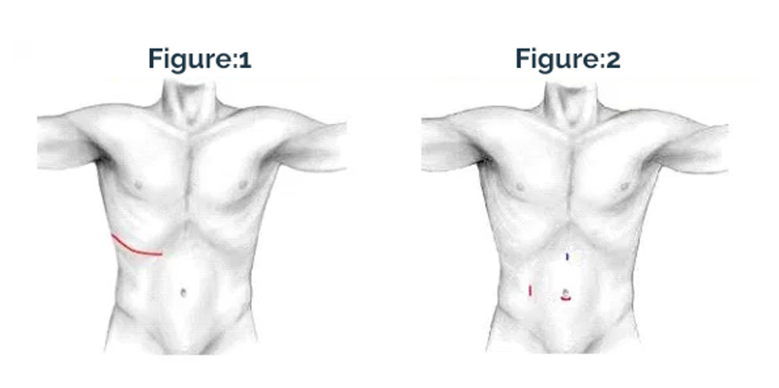 What is Robotic Adrenalectomy