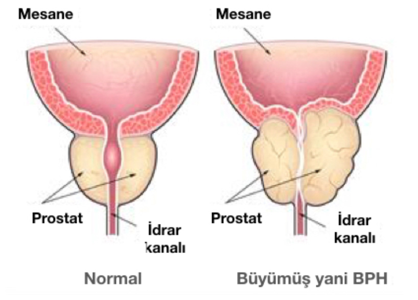 HoLEP (Holmium Lazer) ile Prostat Cerrahisi