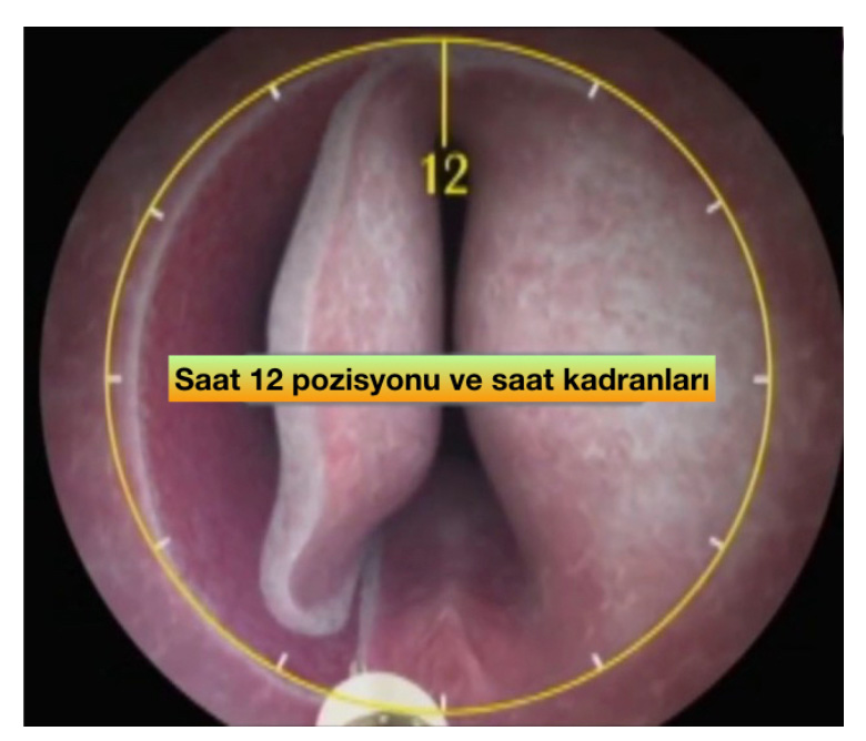HoLEP (Holmium Lazer) ile Prostat Cerrahisi