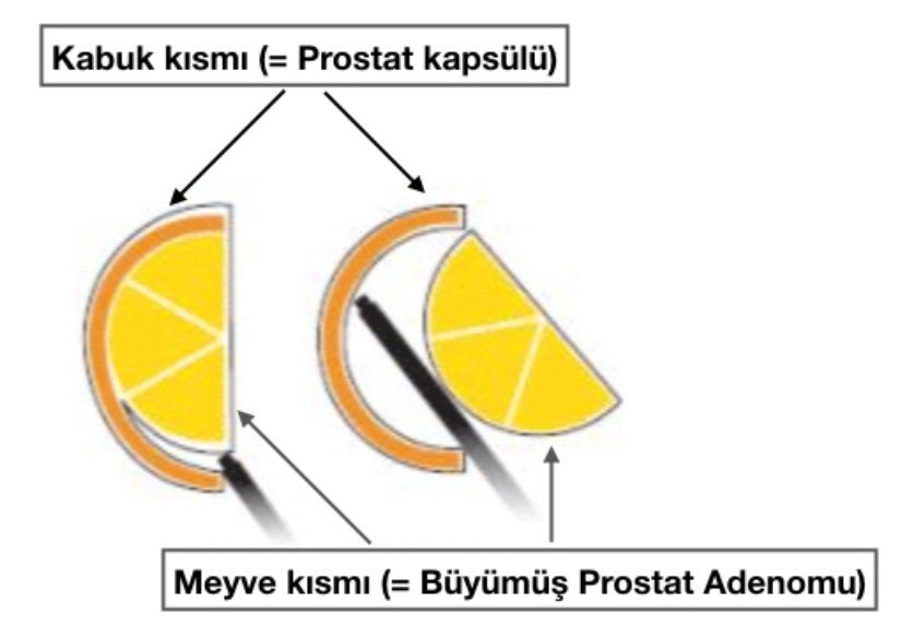 HoLEP (Holmium Lazer) ile Prostat Cerrahisi