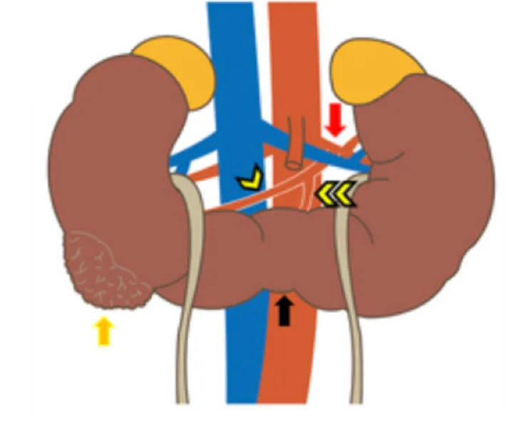 Robotic Surgery of Renal Cancer in Horseshoe Kidney