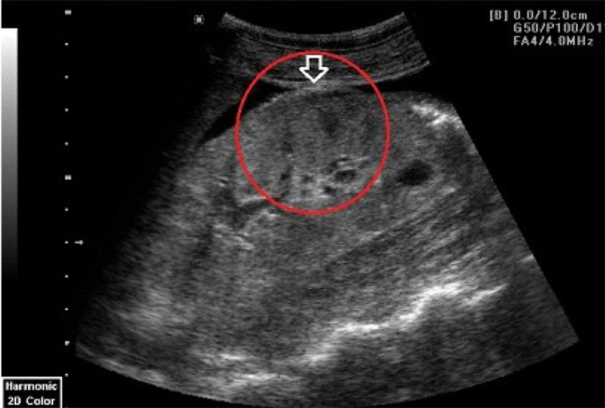 Kidney Cancer