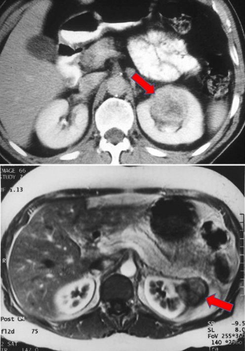 Kidney Cancer