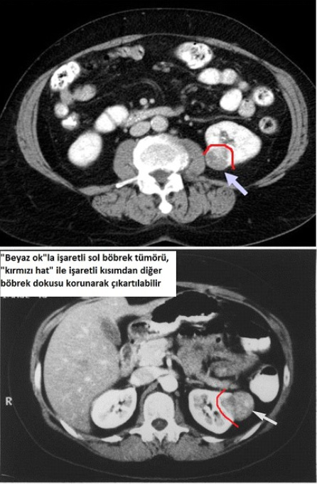 Kidney Cancer