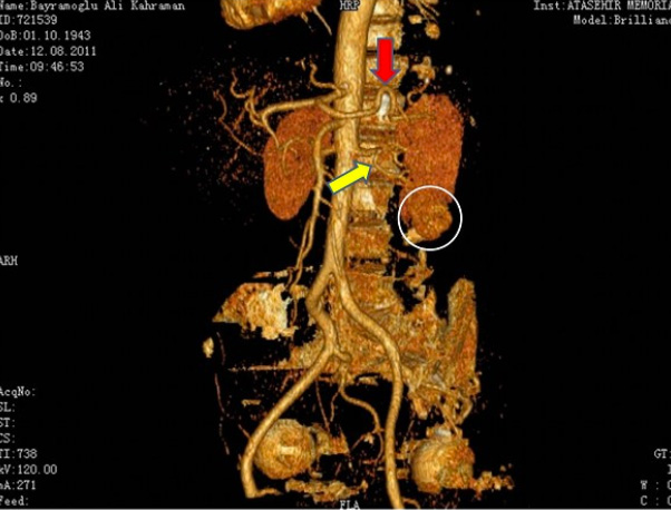 Kidney Cancer