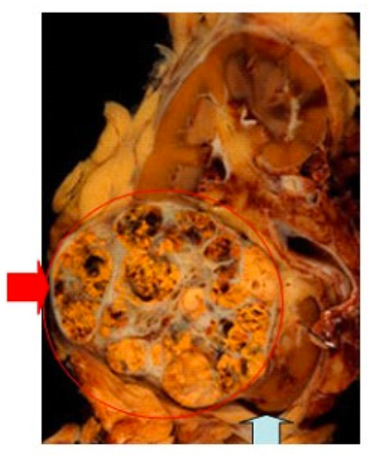 Kidney Cancer