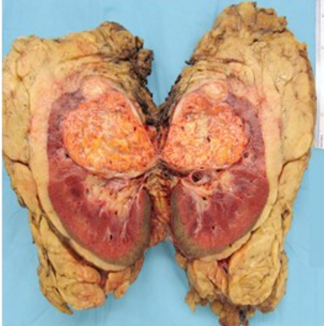 Kidney Cancer