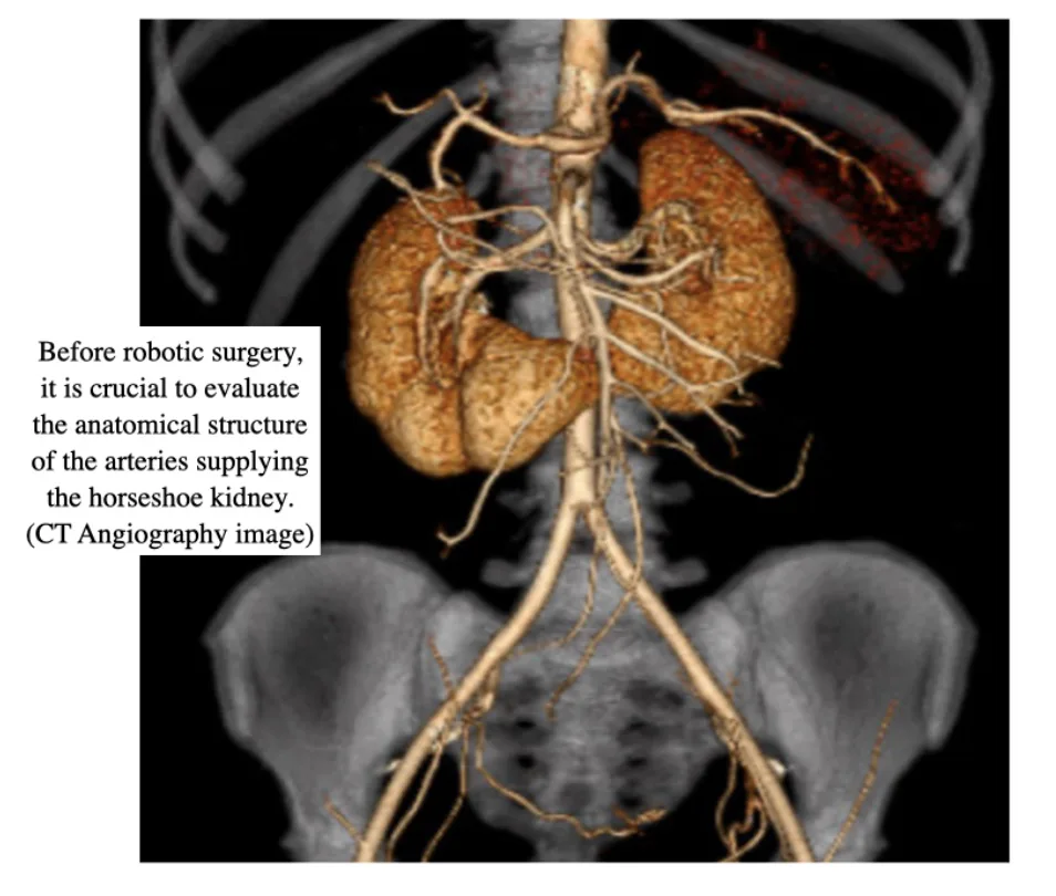 Robotic Surgery of Renal Cancer in Horseshoe Kidney