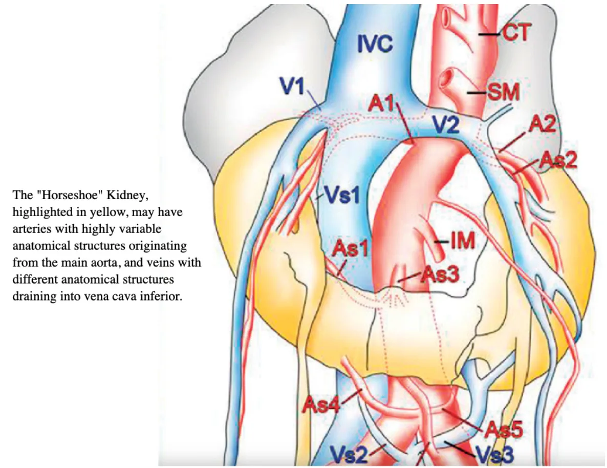 Robotic Surgery of Renal Cancer in Horseshoe Kidney