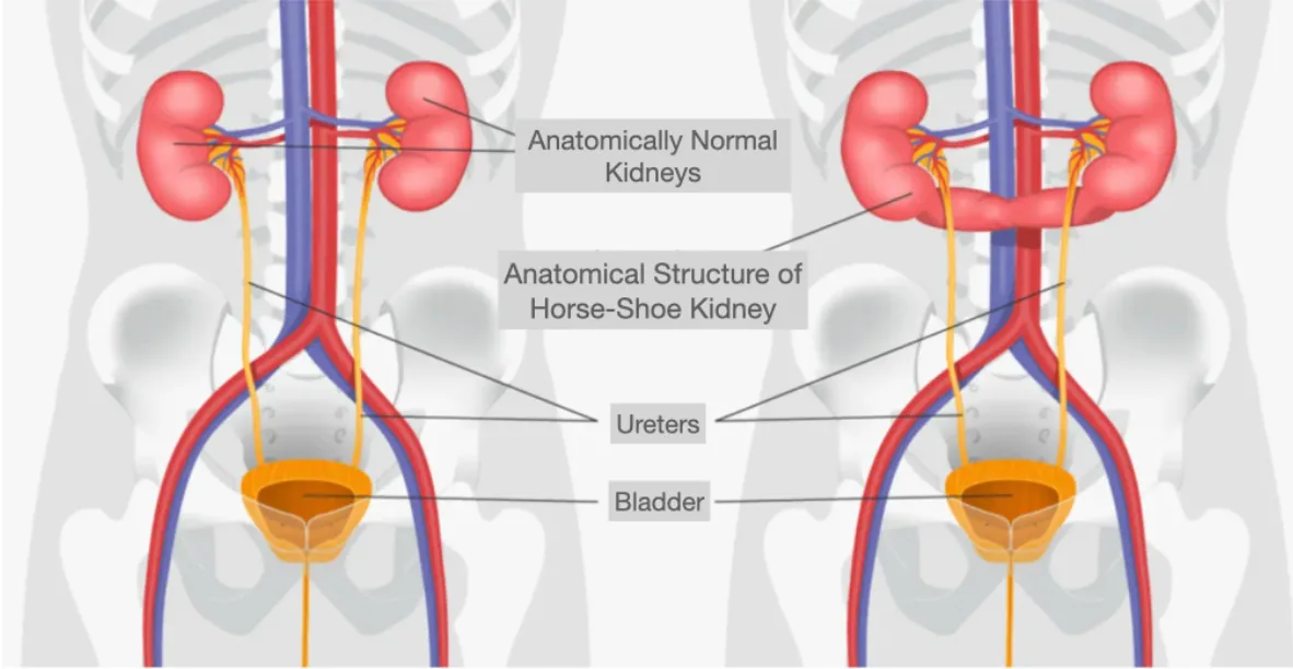 Robotic Surgery of Renal Cancer in Horseshoe Kidney