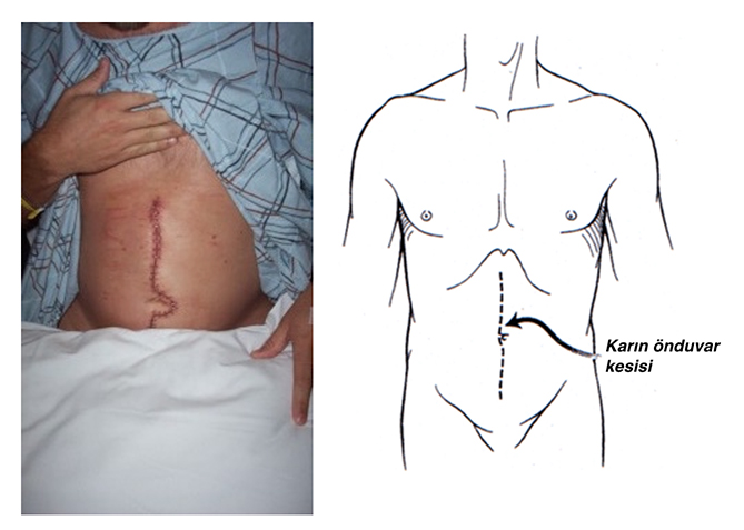 Retroperitoneal Lenf Nod Disseksiyonu (RPLND) ne demektir?