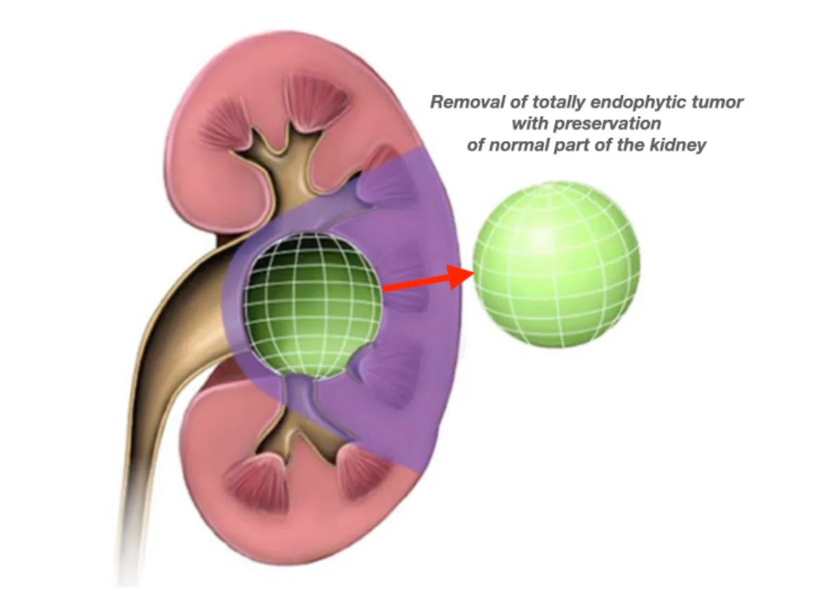 Robot Assisted Partial Nephrectomy