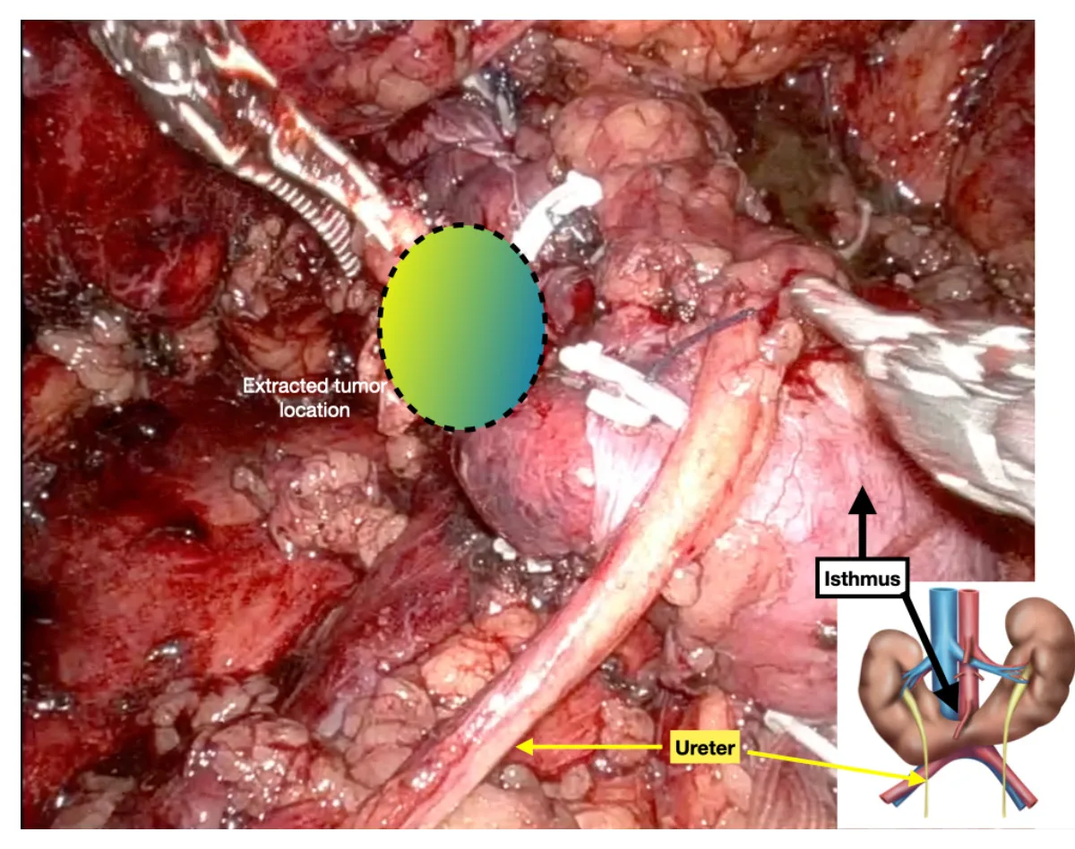 Robotic Surgery of Renal Cancer in Horseshoe Kidney