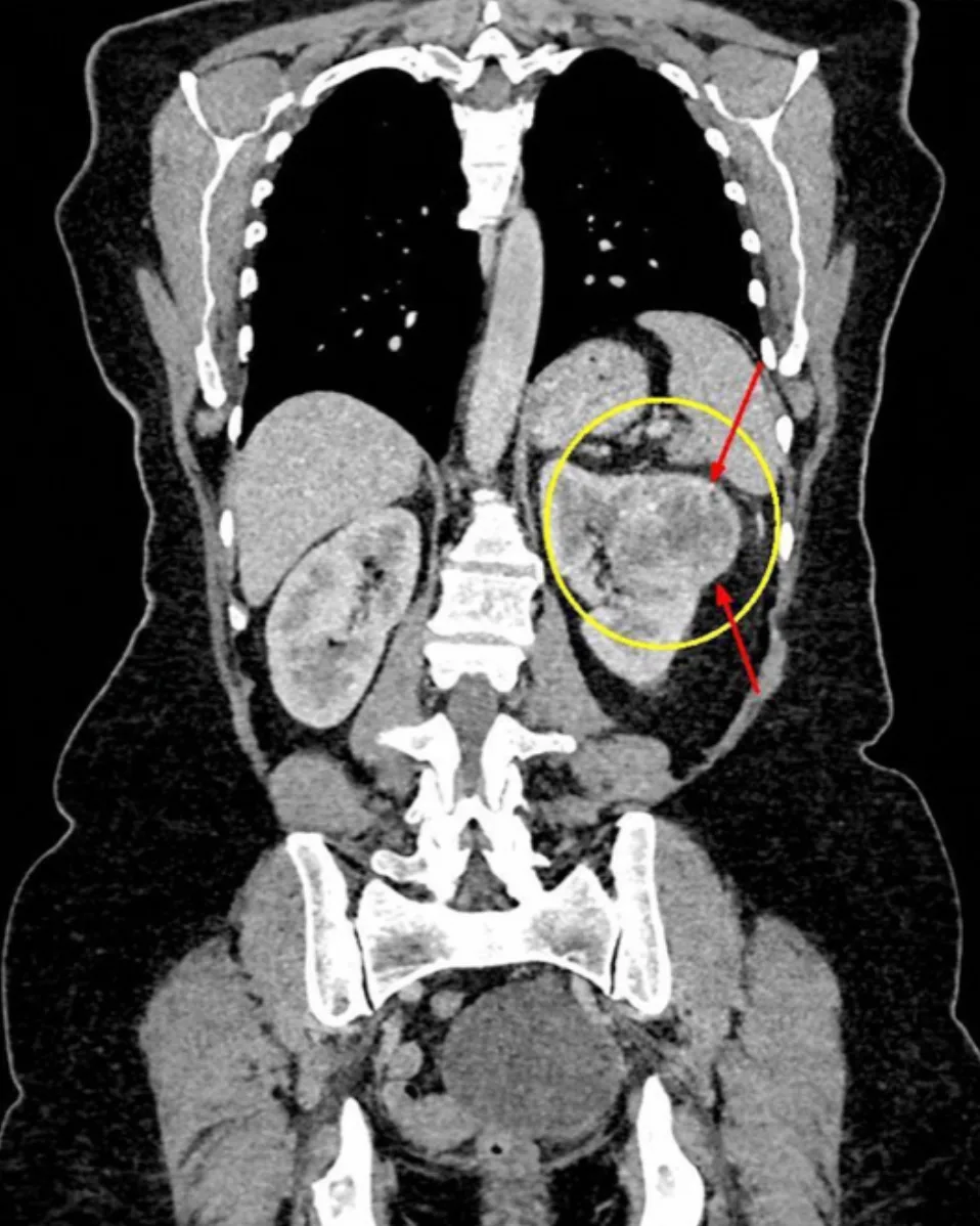 Robot Assisted Partial Nephrectomy