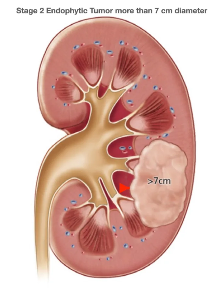 Robot Assisted Partial Nephrectomy