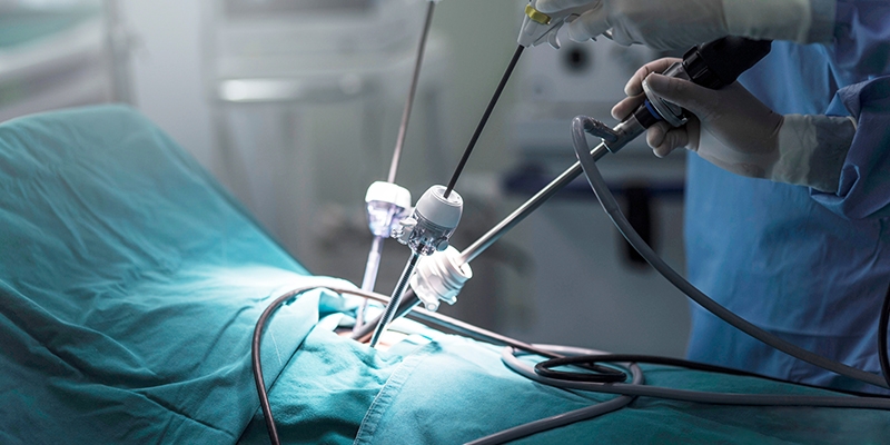 Resim-3: İnce borucuklardan, hastada geniş yara açmadan, laparoskopik ameliyatın prostat kanserinde radikal ameliyatın (radikal prostatektomi) gerçekleştirilmesi.