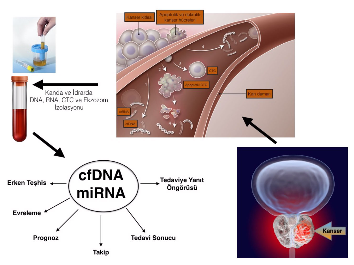 Prostat Kanseri Teşhisinde Likid Biopsi Nedir?