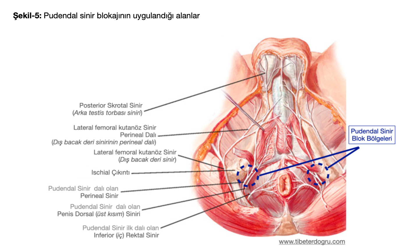 Erken Boşalma Tedavisinde Pudendal Sinir